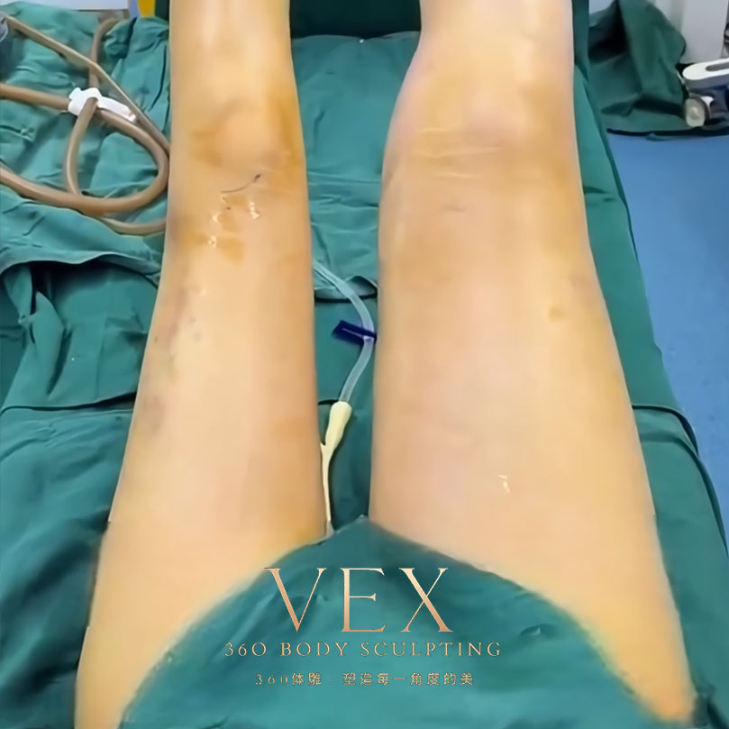 Leg before & after – a 29-year-old girl weighing 65kg.