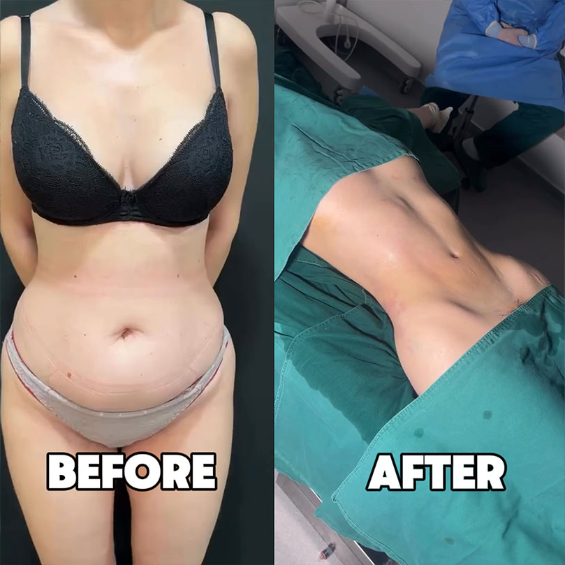 Belly fat won't stop her from getting V-line abs.