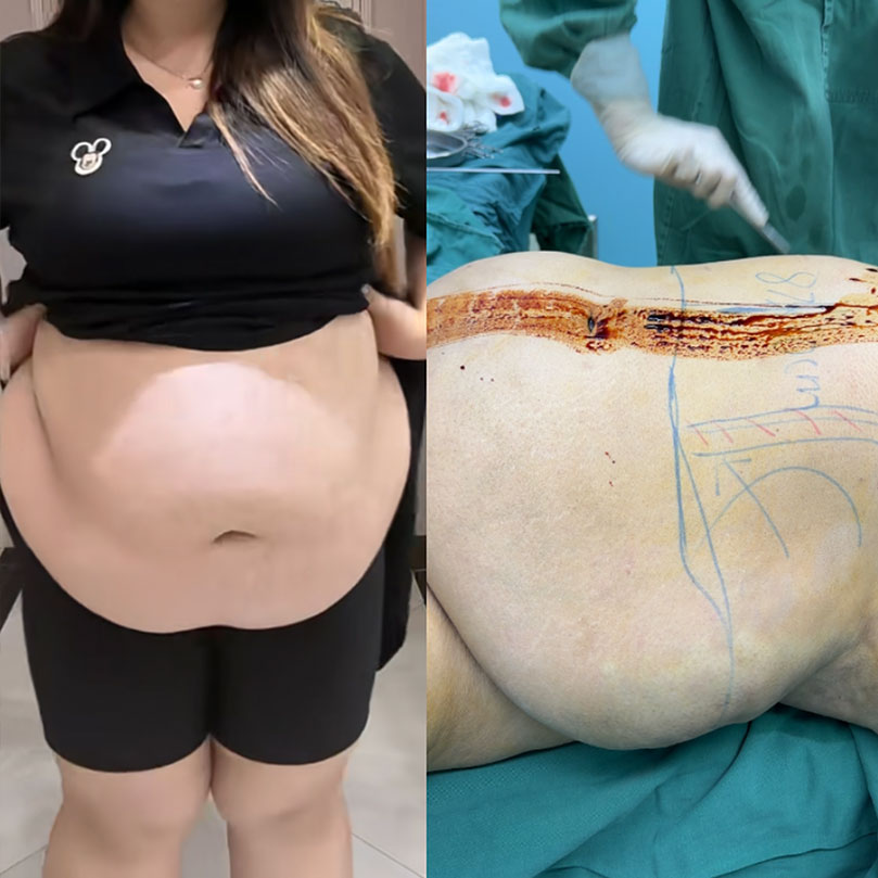 August 6, 2026 – Real Recording: A 102kg Patient Undergoing VEX360lipo Liposuction.