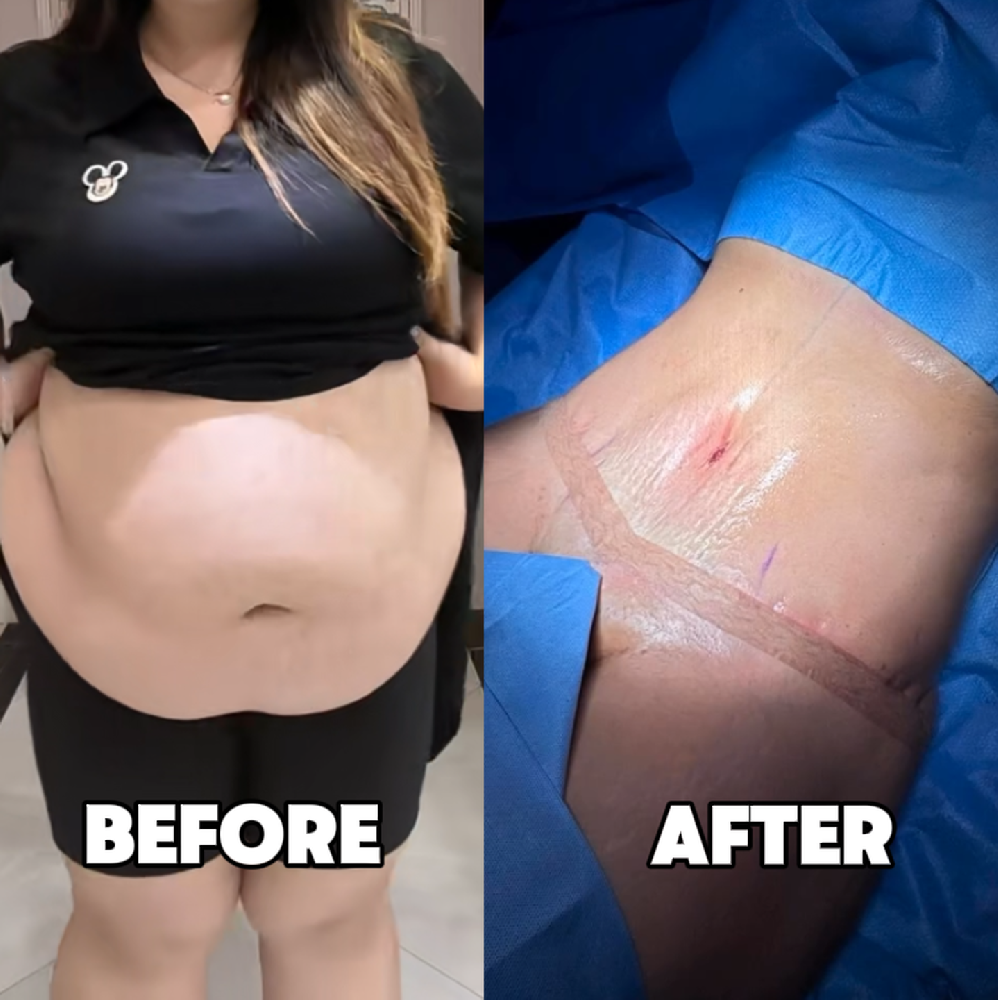 Aug 7, 2026 – 102kg belly before vs after – real recording!