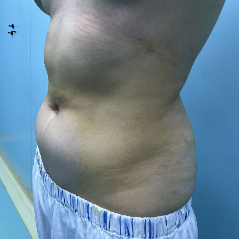 A girl from New Zealand, 88kg, with stubborn belly fat – and she wants V-line abs too.