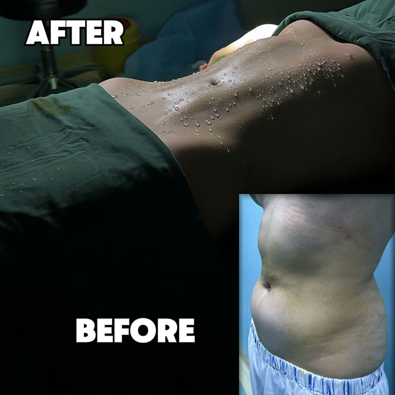 Before & After: 88kg Belly Transformation.