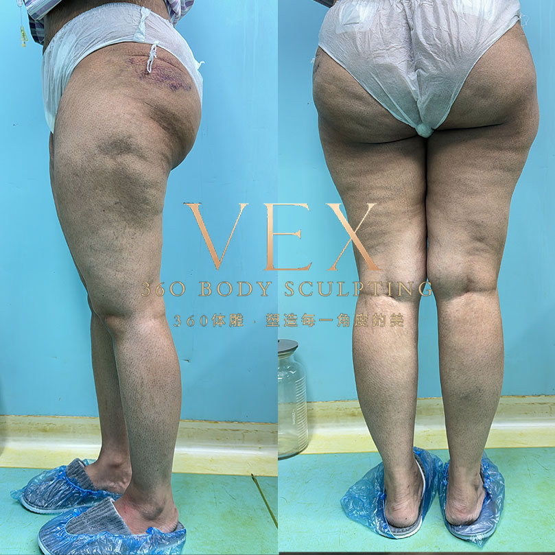 Episode 1 – Thai Girl's Thigh Transformation Begins!