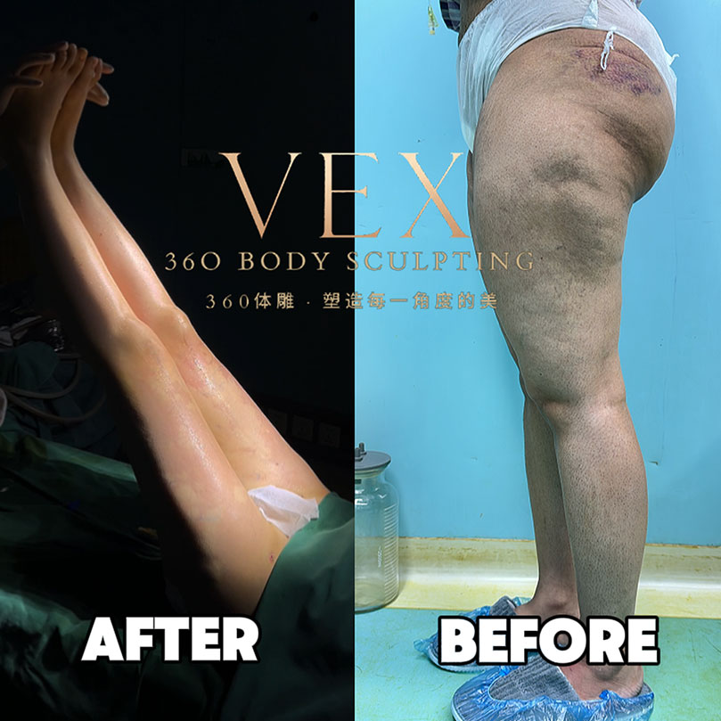 Before vs After – Thai girl's thigh transformation update!