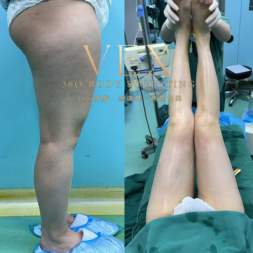 Update: Singaporean girl's thigh transformation – before vs after!