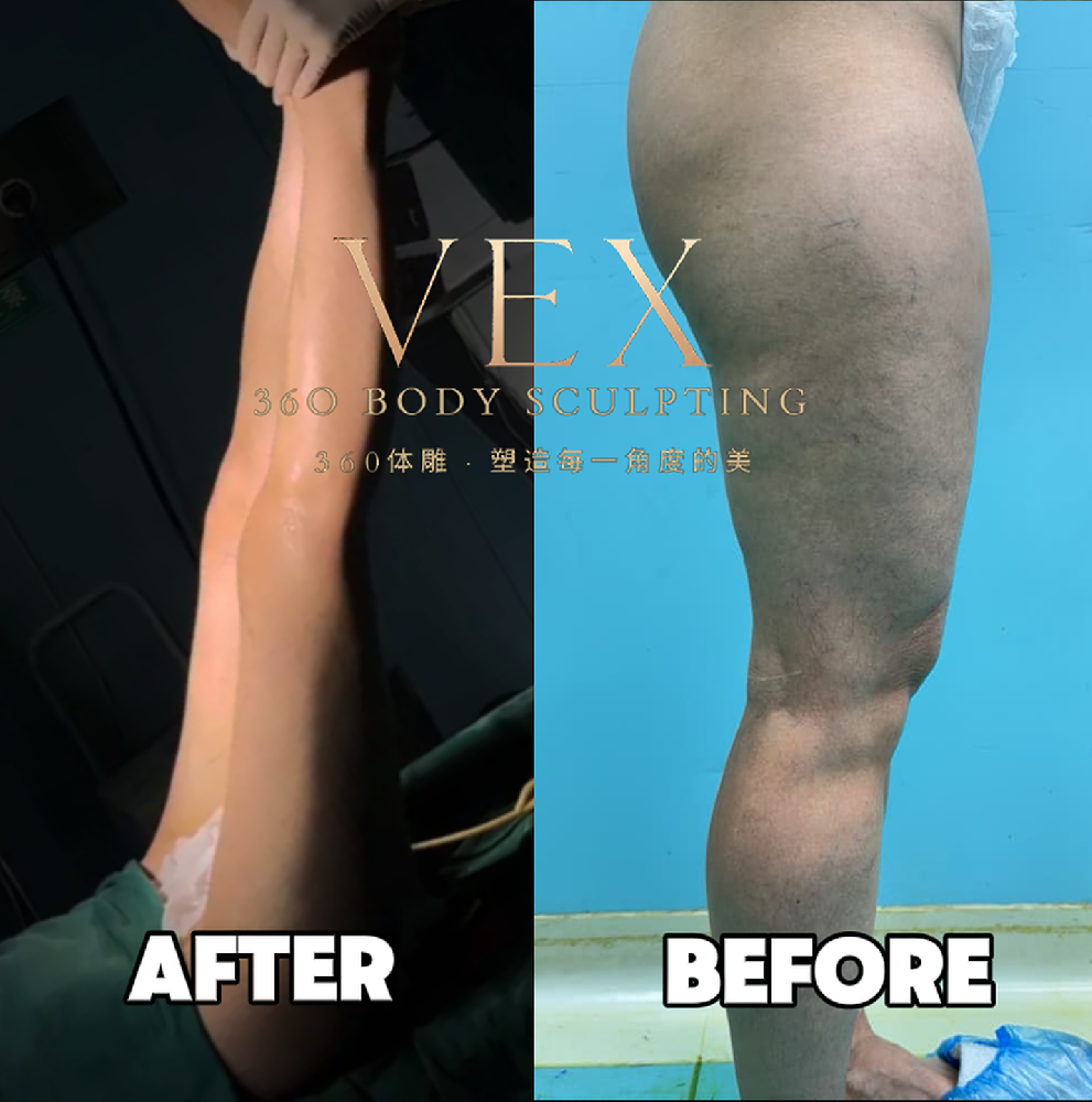 Singaporean Girl's Thigh Lipo Update – Part 2.